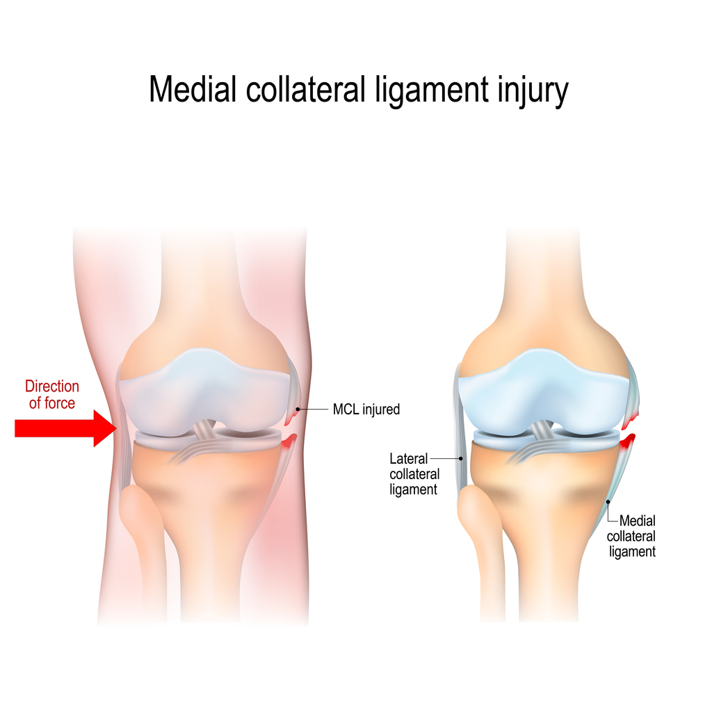 Medial knee injuries.